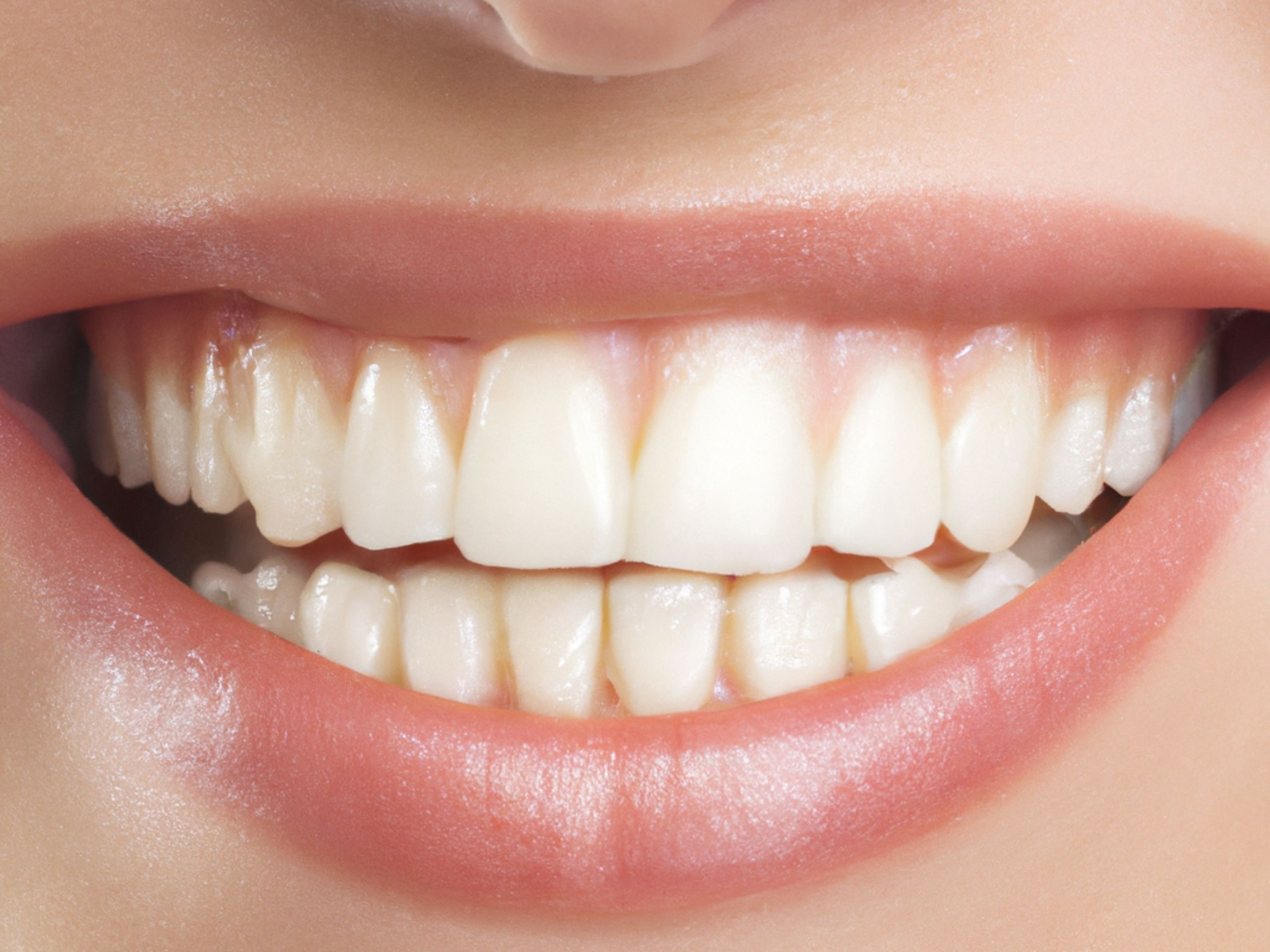 Dental crown on model teeth